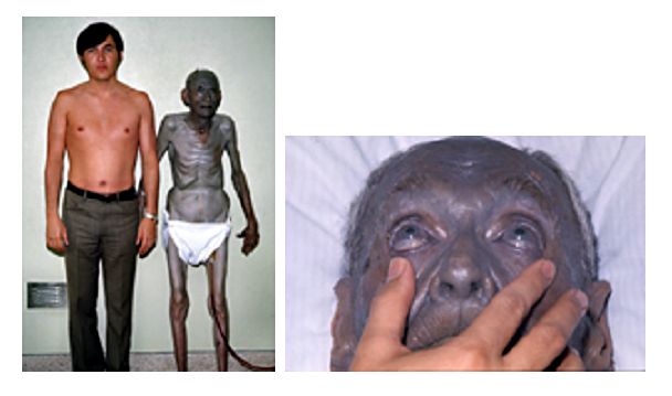 Argyria