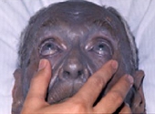 Argyria