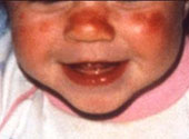 Lupus