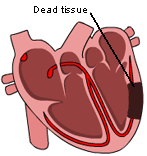 Infarct
