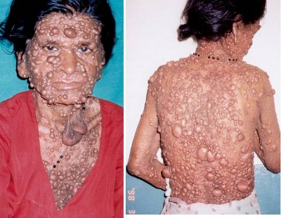 Neurofibromatoza Neurofibromatoza