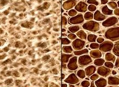 Osteoporoza