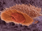 Celula canceroasa