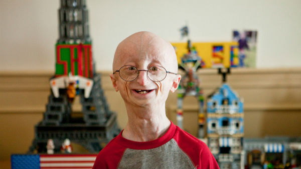 Progeria
