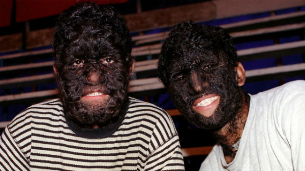Hypertrichosis