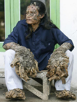 epidermodzsplasia-verruciformis