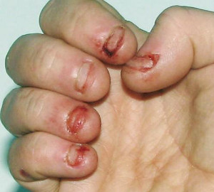 Lesch-Nyhan-Syndrome