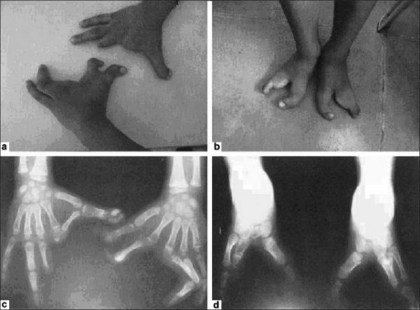 Ectrodactyly