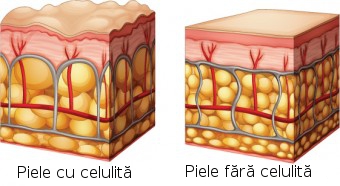 Celulita Celulita