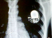 Pacemaker