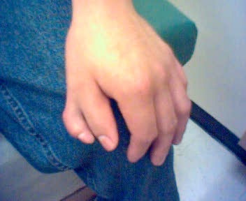 Polidactilie