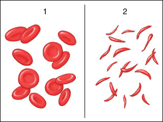 Hematii normale vs hematii in secera in siclemie Hematii normale vs hematii in secera in siclemie