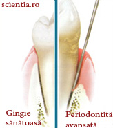PeriPeriodontită Periodontită