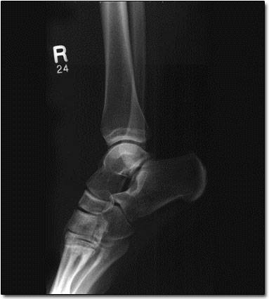 Radiografie glezna