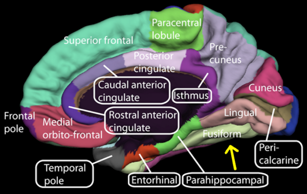 Girusul fusiform Girusul fusiform